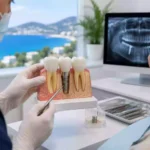Bodrum Diş İmplant Tedavileri